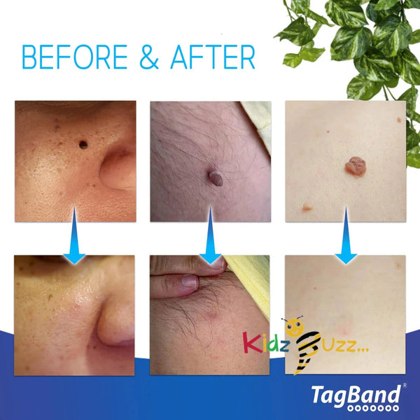 Auto Skin Removal Tag-Fast Effective Safe Skin Tag Remover